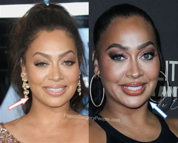 Lala Anthony Plastic Surgery (Part 1 Face Edition) plasticsurgery