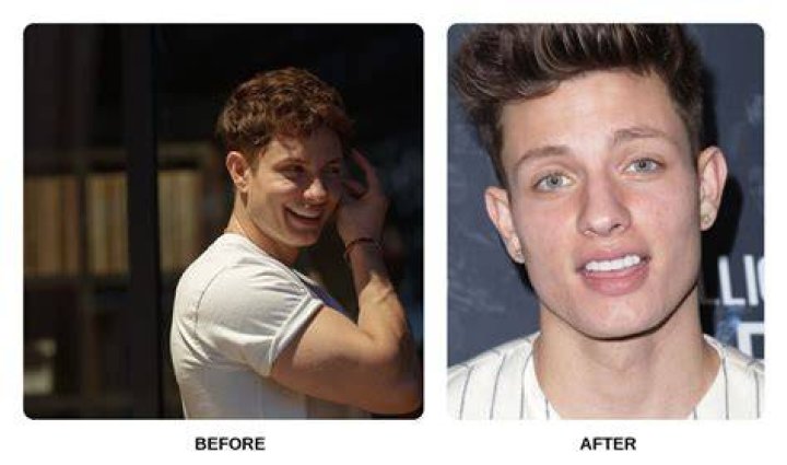 Matt Rife Before Fixing His Teeth The Wild &lsquo;n Out Star&rsquo;s Glow Up Examined!