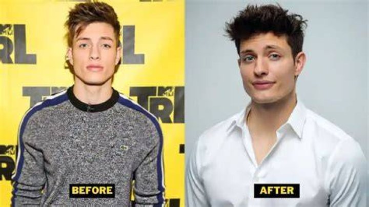 Matt Rife Plastic Surgery