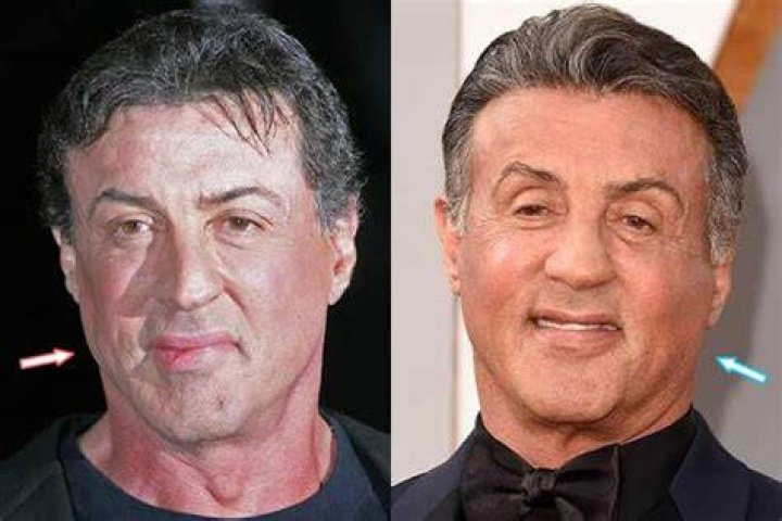 Sylvester Stallone Plastic Surgery Hair, Facelift, Botox, Nose Job?