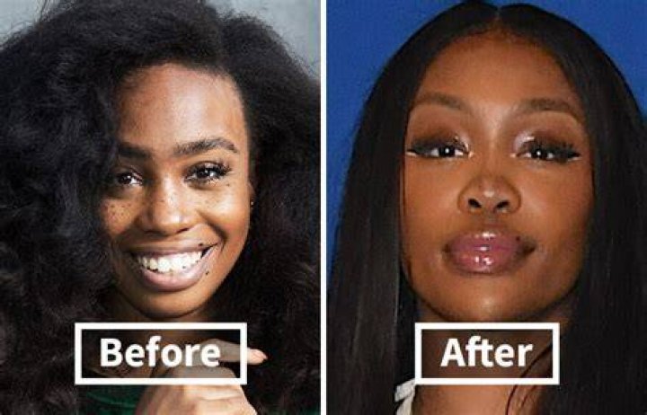 SZA confirms plastic surgery procedure